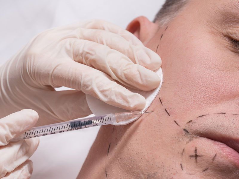 Laser Hair Removal